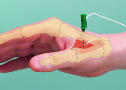 Spasticity Treatment Market