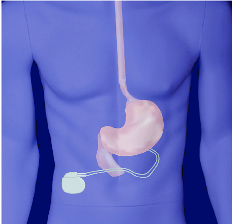 Global Gastric Electrical Stimulators Market