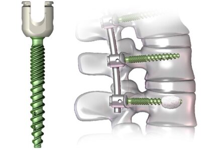 Pedicle Screw Systems Market