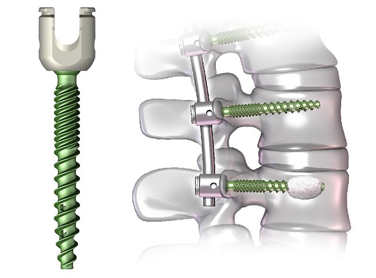 Pedicle Screw Systems Market