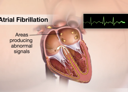 Atrial Appendage Occluder Market