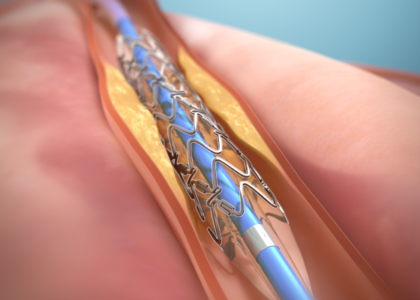 India Coronary Stent Market