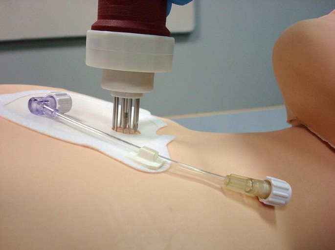 Intraosseous Infusion Devices Market