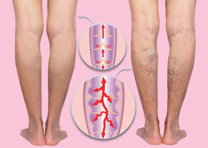 Varicose Vein Treatment Market