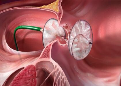 Anorectal Malformation Treatment Market