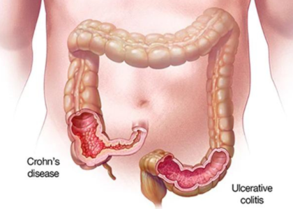 Crohn’s Disease (CD) Treatment Market