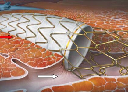 Gastrointestinal Stent Market