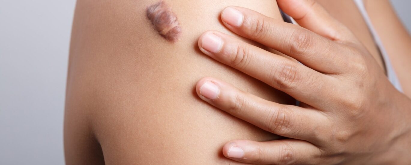 Keloid Treatment Market