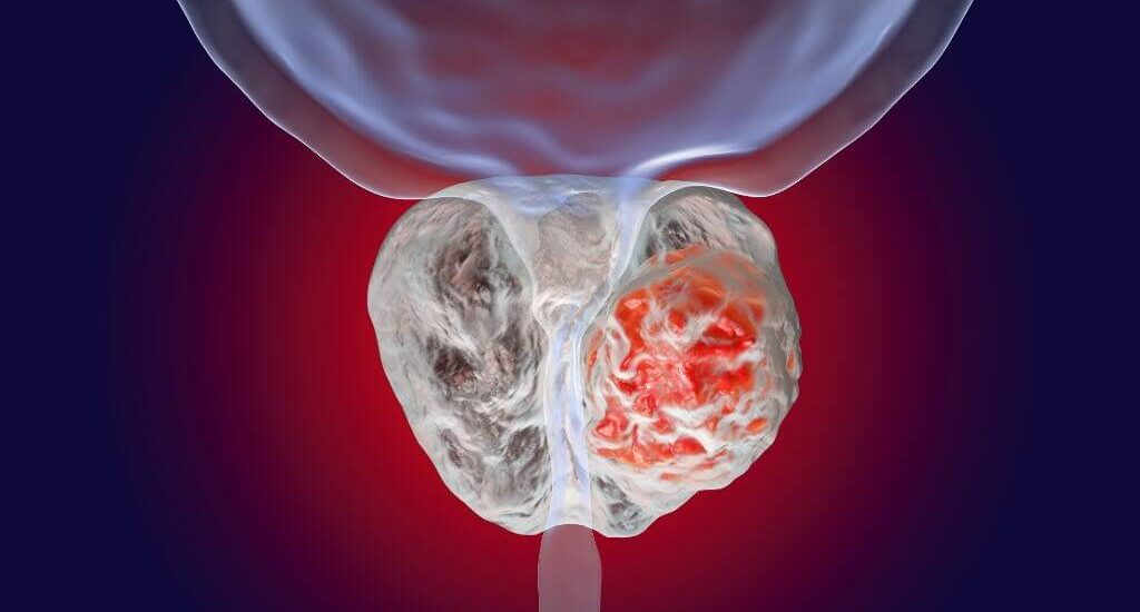 Prostate Cancer Market