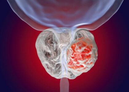 Prostate Cancer Market