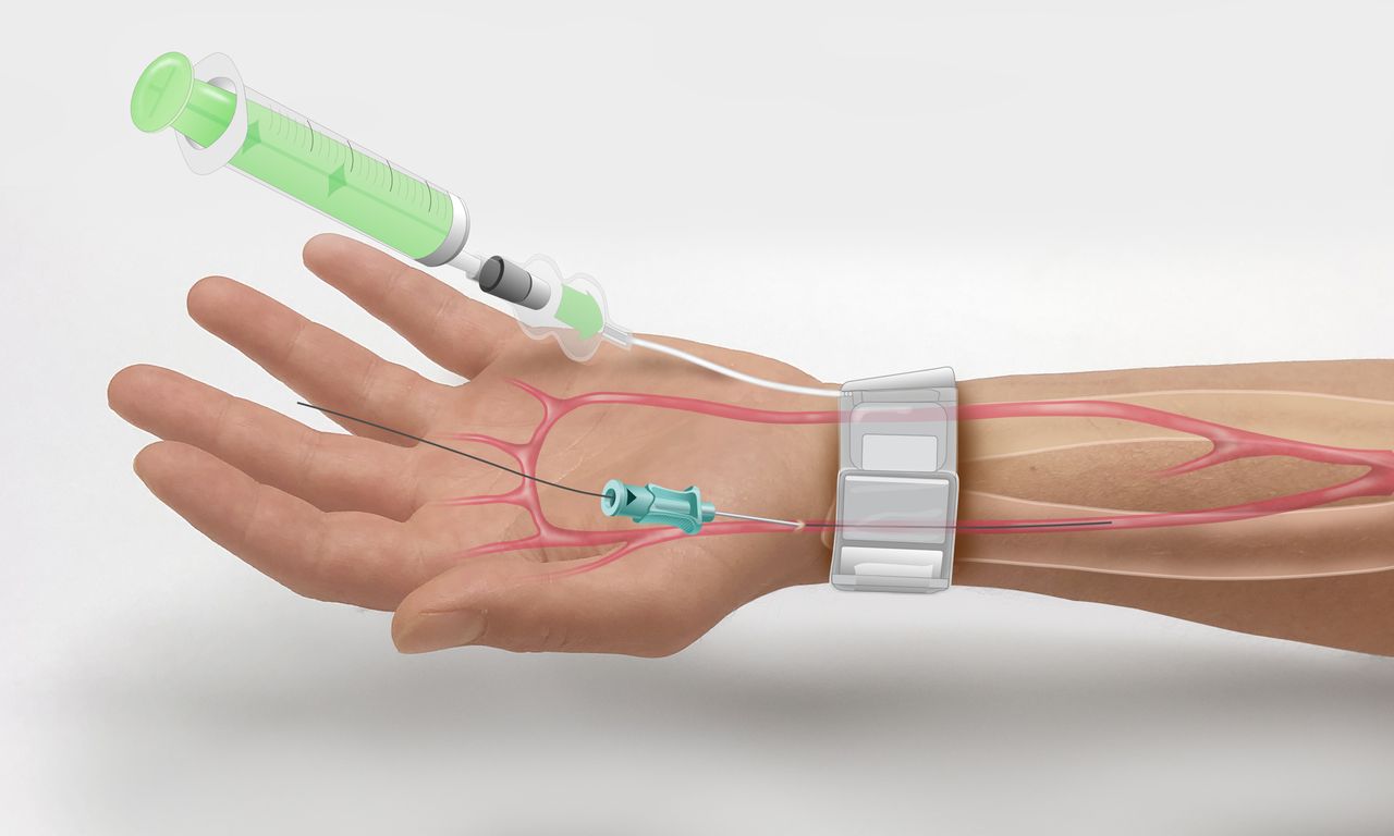 Radial Compression Devices Market Poised for Substantial Growth, Envisioned to Reach US 599.9