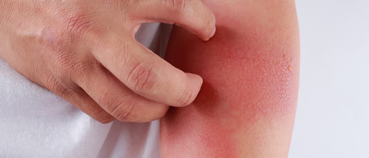 Canine Atopic Dermatitis Treatment Market