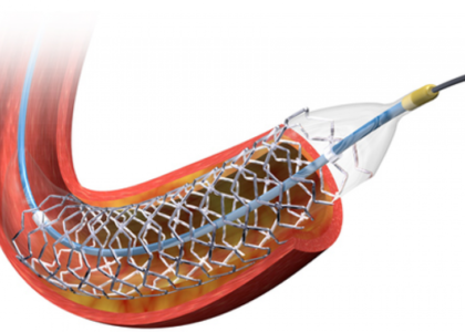 Coronary Stents Industry