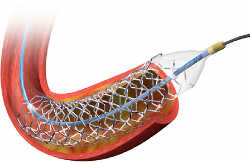 Coronary Stents Industry