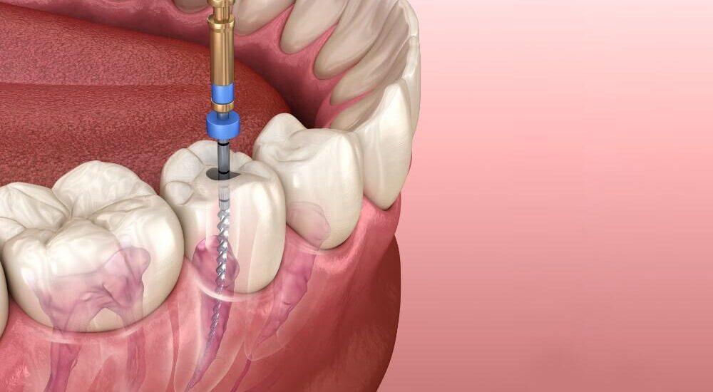Dental Caries and Endodontic Market