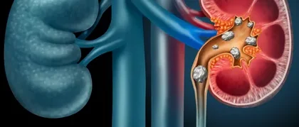 Global Primary Hyperoxaluria Treatment Market