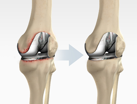 Revision Knee Replacement Industry