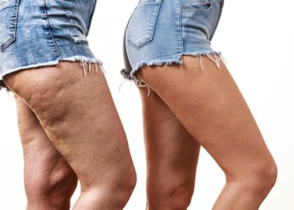 Cellulite Treatment Industry