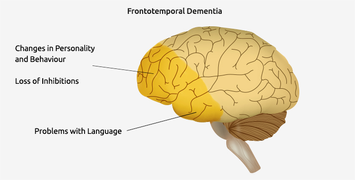 Frontotemporal Dementia Management Industry