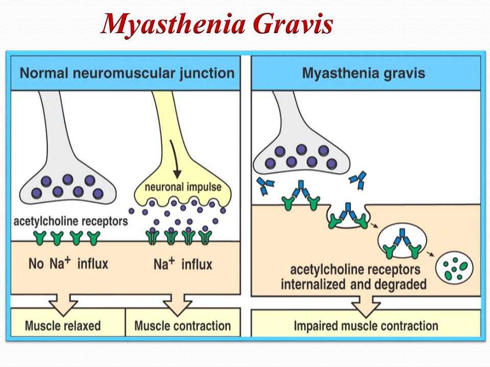 Global Generalized Myasthenia Gravis (GMG) Management Industry is anticipated to reach US$ 2.96 Billion by 2033 Generalized Myasthenia Gravis (GMG) Management Industry
