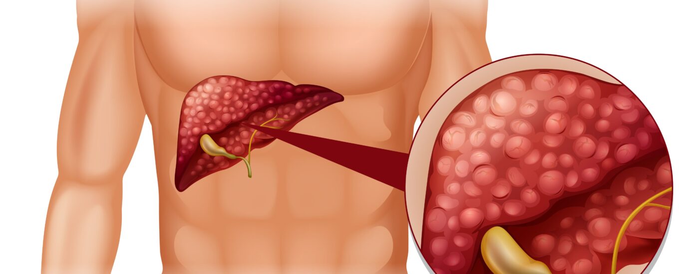 Neuroendocrine Carcinoma Treatment Market