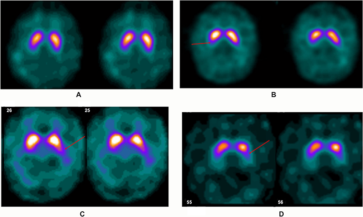 Single-Photon Emission Computed Tomography Market