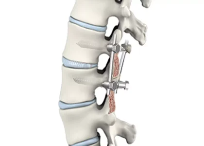 Spinal Fusion Market