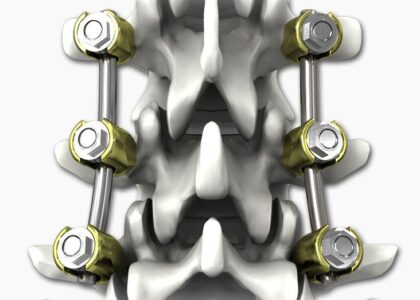Global Spinal Osteosynthesis Units Market