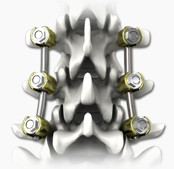 Global Spinal Osteosynthesis Units Market