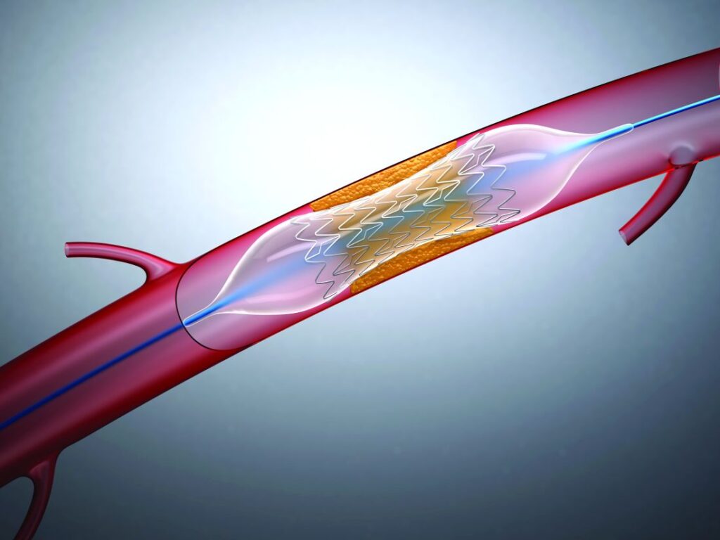 Thoracic Vascular Stent Grafts Industry