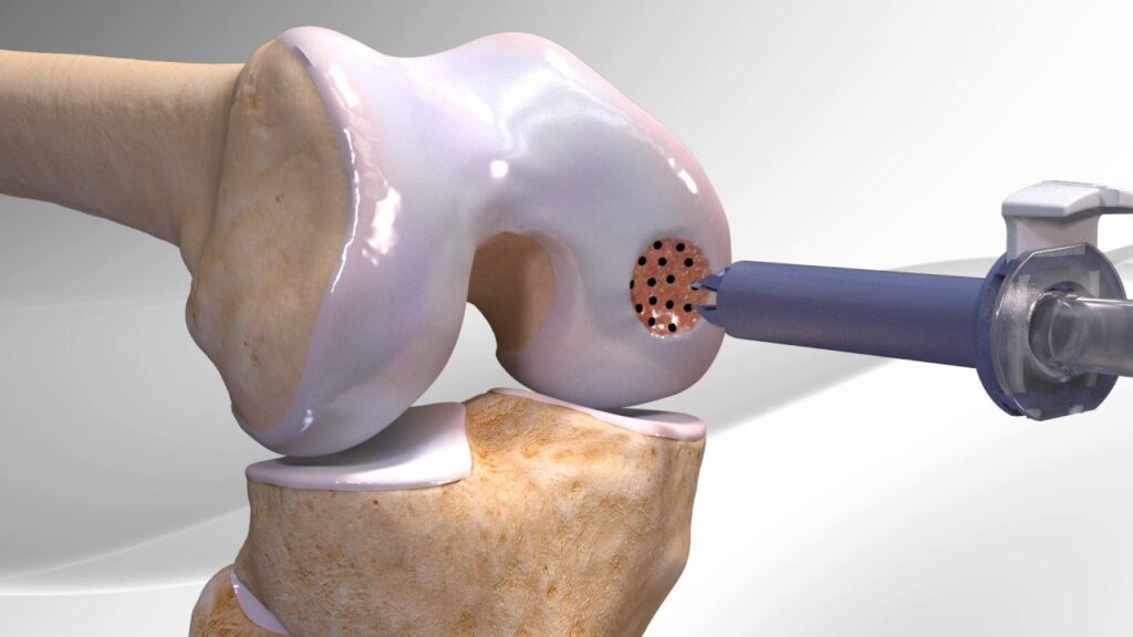 Cartilage Repair Industry