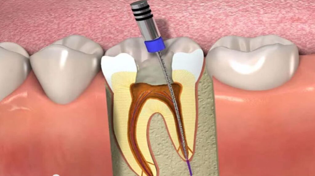 Dental Caries And Endodontic Industry