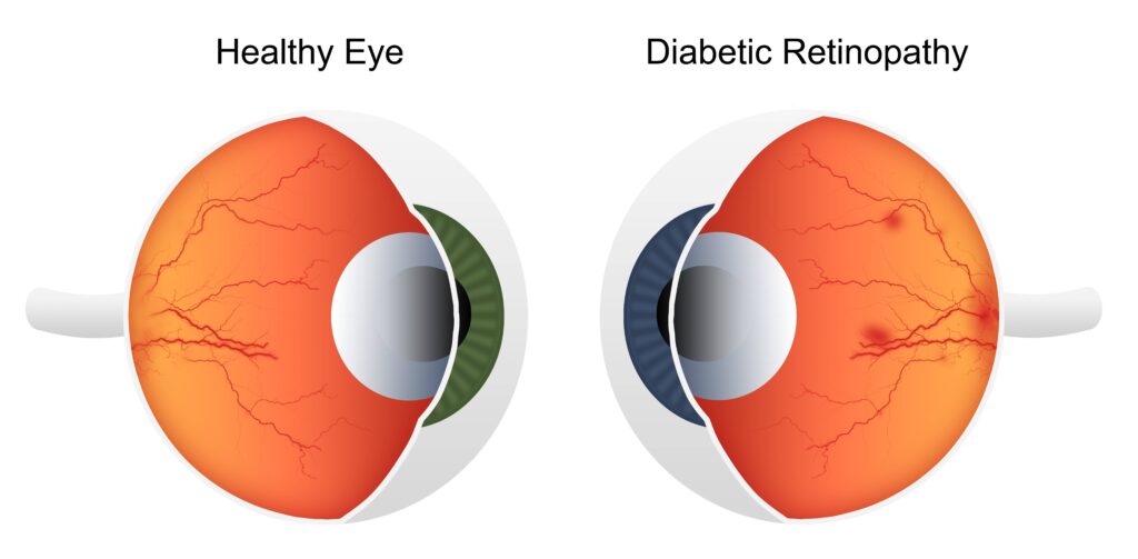 Global Diabetic Retinopathy Industry