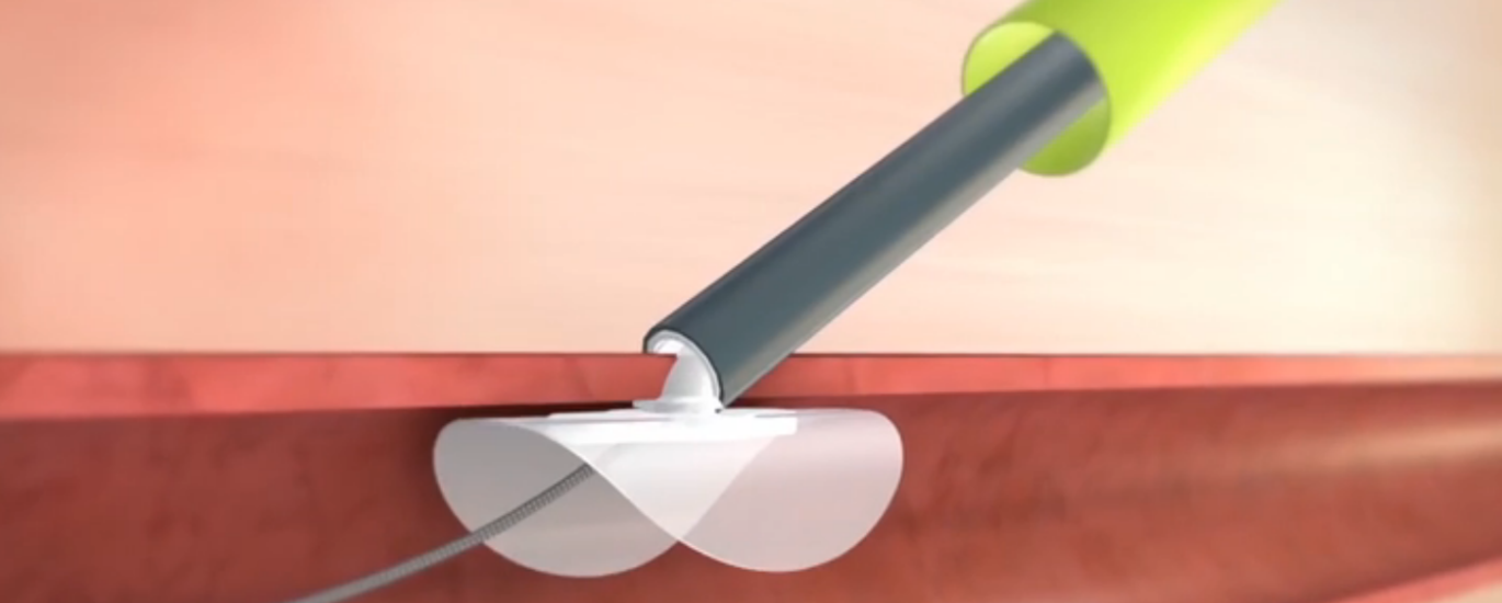 Global Vascular Closure Devices Market