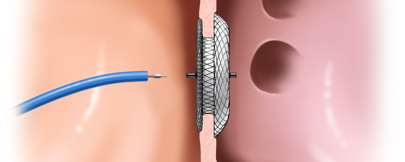 Heart Closure Devices Market