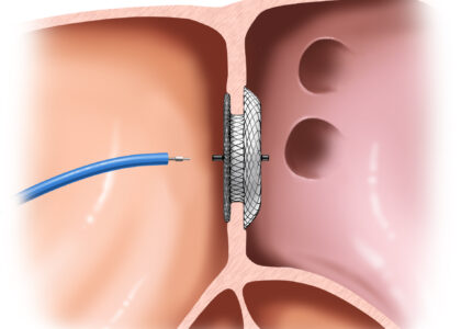 Heart Closure Devices Market
