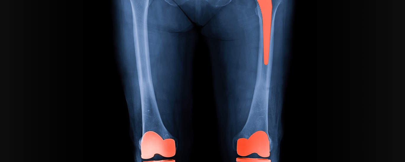 Hips & Knees Reconstructive Market