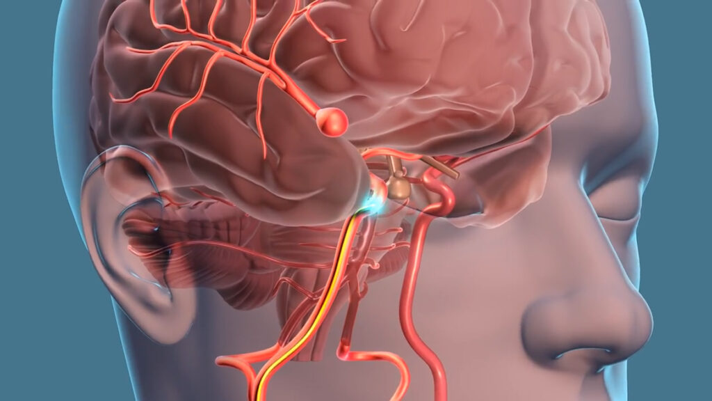 Global Intracranial Aneurysm Industry is Projected to Surge at an Impressive CAGR of 8.8%, Anticipated to Reach US$ 2.56 Billion by 2032 Intracranial Aneurysm Industry