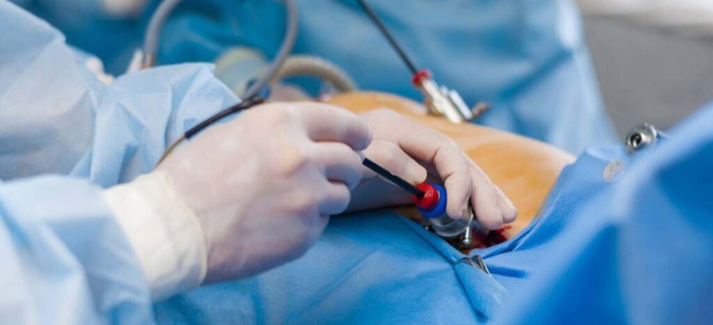 Laparoscopic Gynaecological Procedures Industry