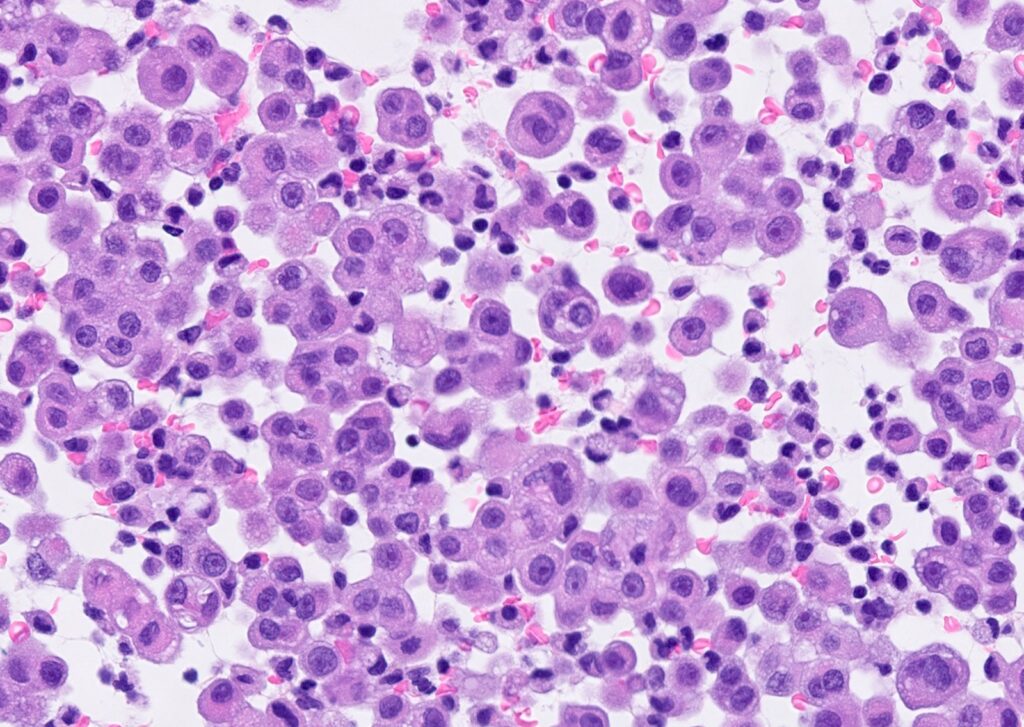 Malignant Pleural Effusion Market Malignant Pleural Effusion Market