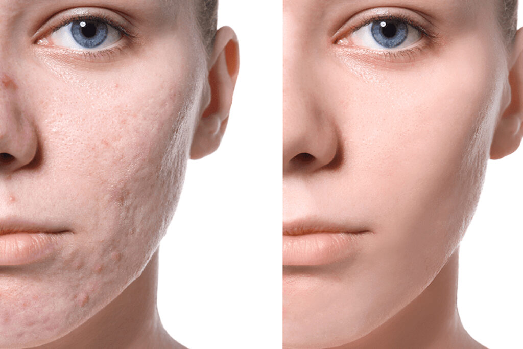 Skin Tears Treatment Industry