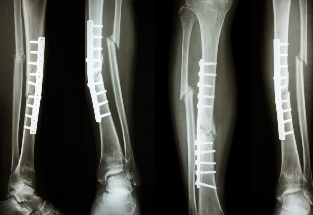 Bone Fixation Plates Industry