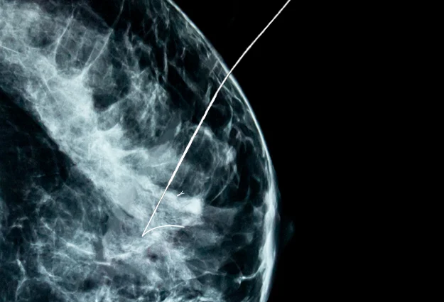 Breast Lesion Localization Market