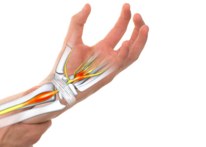 Global Carpal Tunnel Release Systems Industry