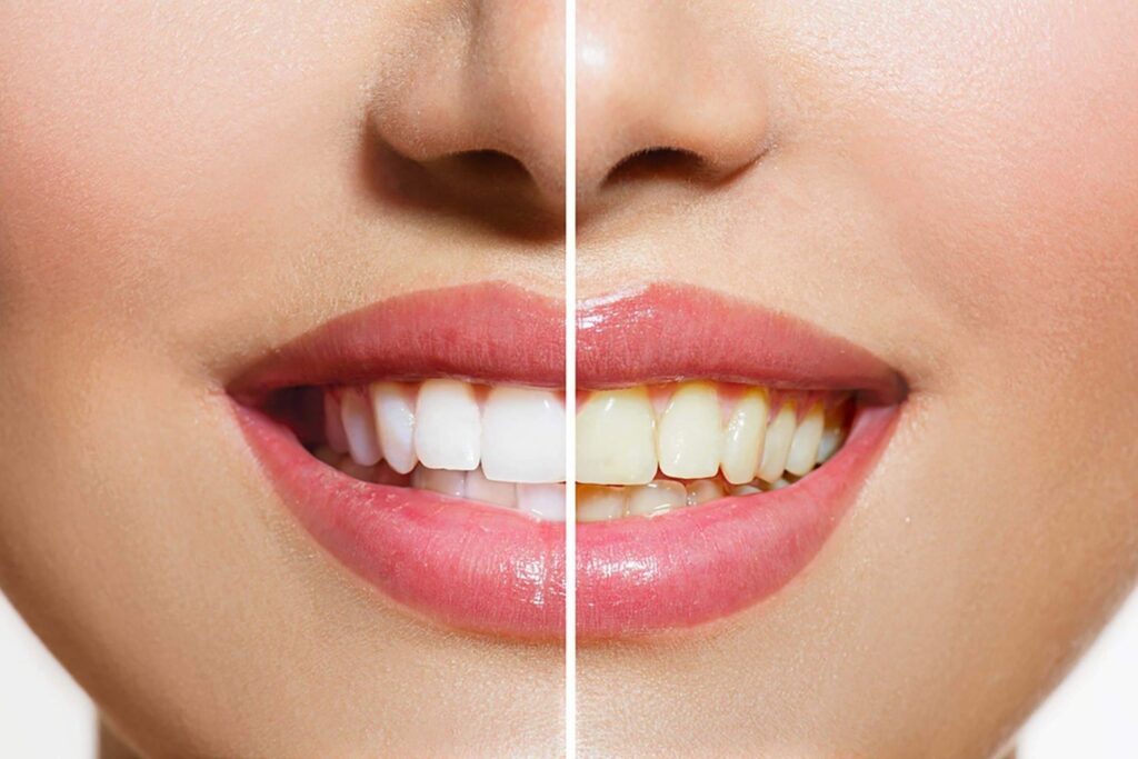 Dental Bleaching Agent Market