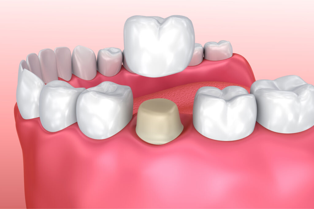 Global Dental Crown Removal Market