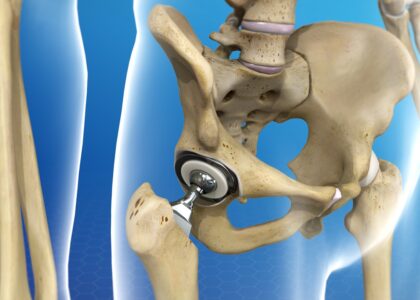Pelvic Reconstruction Market