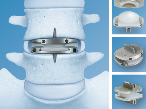 Global Vertebroplasty and Kyphoplasty Devices Industry