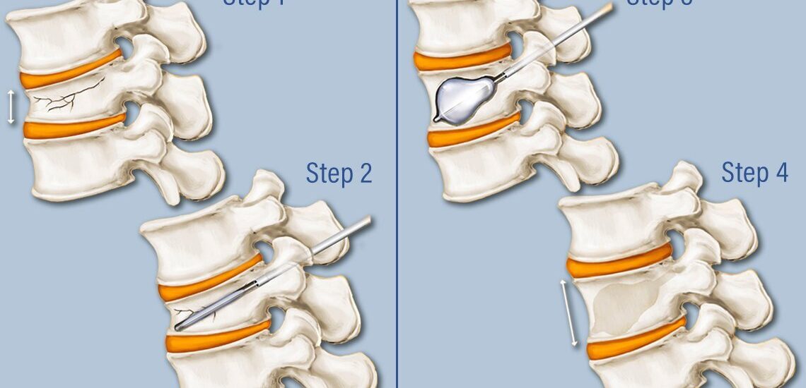Global Vertebroplasty And Kyphoplasty Devices Industry