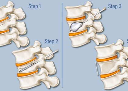 Global Vertebroplasty And Kyphoplasty Devices Industry